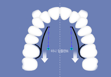 미니스크류 일러스트