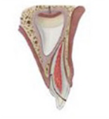 Enamel-dentin pulp fracture