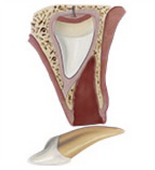 Avulsion