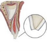 Enamel fracure