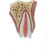 Enamel-dentin fracture