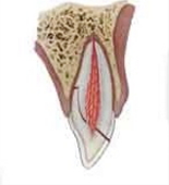 Root fracture